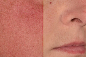 Remederm Dry Skin: intensieve verzorging voor de droge huid
