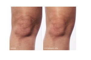 Pico Laser: voor verwijdering tatoeages, PMU en pigment