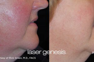 Oppervlakkige huidproblemen verhelpen <em><u>met Laser Genesis</u></em>