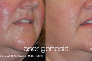 Oppervlakkige huidproblemen verhelpen <em><u>met Laser Genesis</u></em>