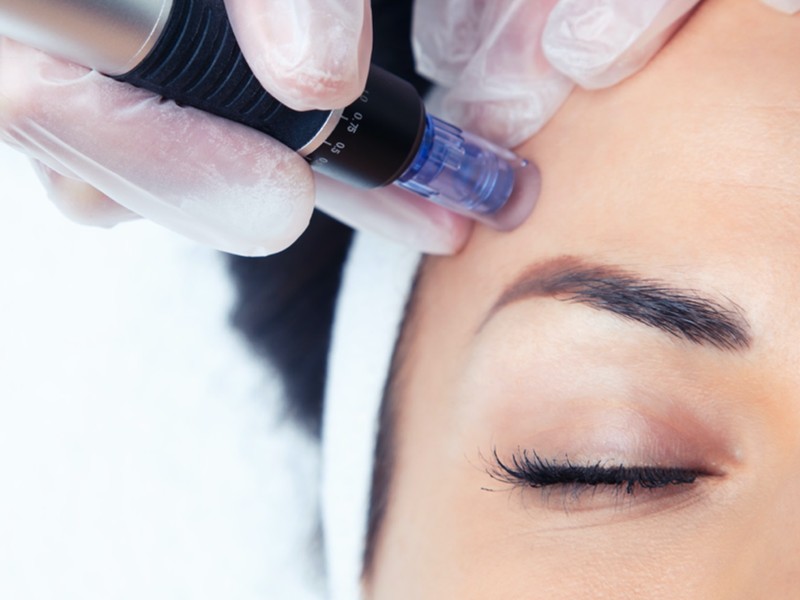 Online Masterclass Micropeeling bij Skindependent Academy