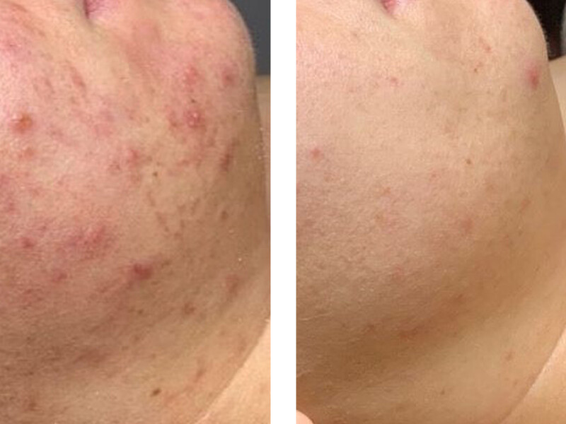 Piura Bio Peeling: effectieve huidvernieuwende behandeling